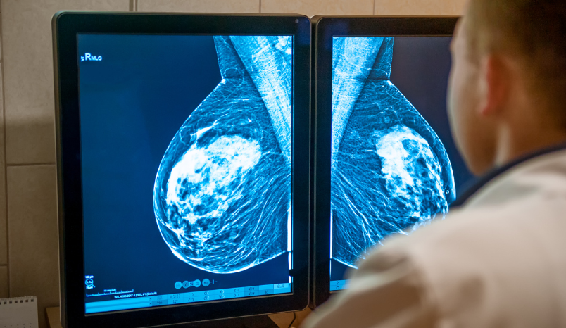 mammogram