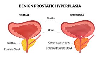 Graphic for Benign Prostatic Hyperplasia